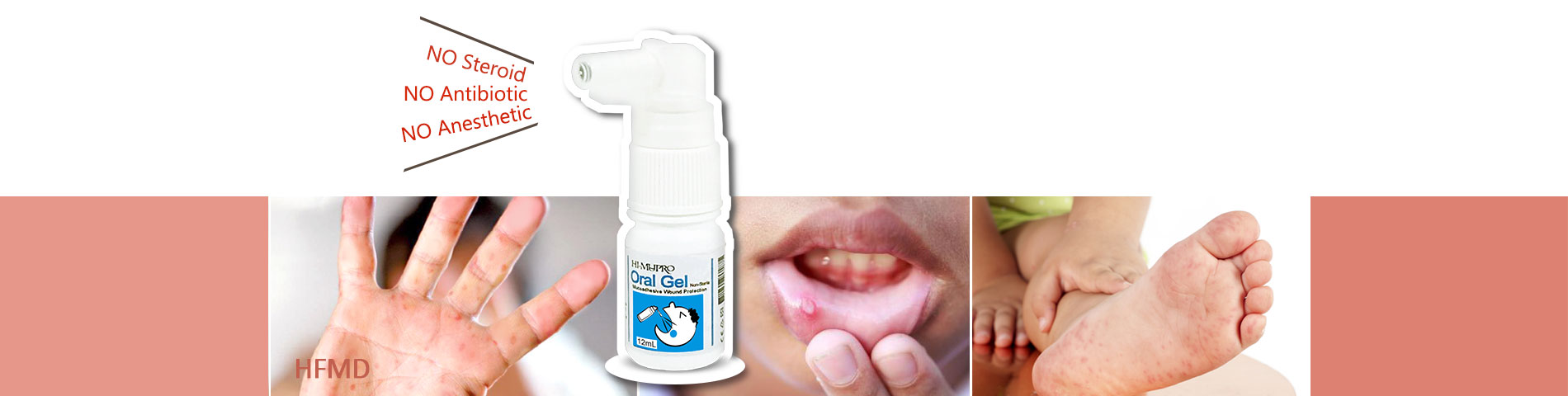 Doença mão-pé-boca e úlceras orais Ajudante de feridas na boca auxiliar de mucosite oral