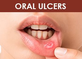 Oral Mucositis Solution