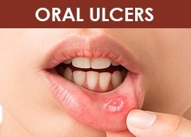 Lösung für orale Mukositis