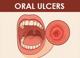 Solução para Mucosite Oral
