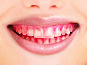 HI-MUPRO помогает вам выработать правильные привычки чистки зубов, чтобы предотвратить образование зубного налета!