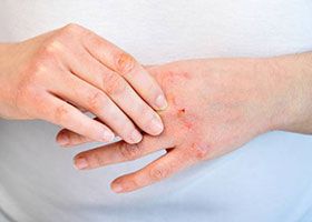 Empfindliche oder angegriffene Haut