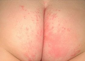 Moisture-Associated Skin Damage (MASD)