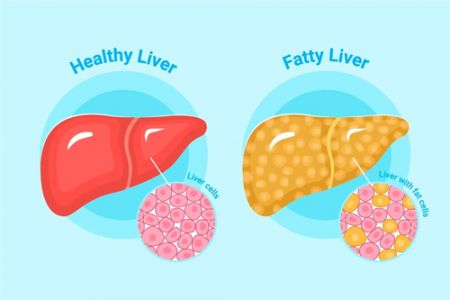 Fatty Liver Disease*